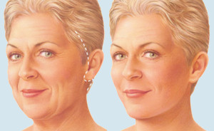 Face Lift, Ritidoplastia