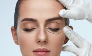 Blefaroplastia